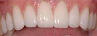 Affordable Porcelain Veneers in Melbourne image 2